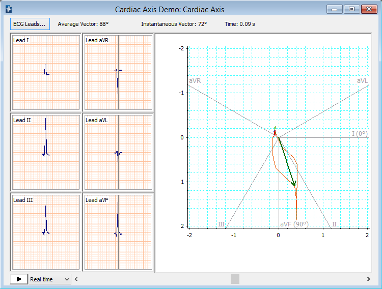 ECG Cardiac Axis Deviation Heart Axis Deviation Calculator ADI